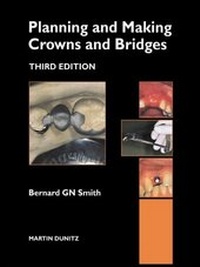 Abbildung von: Planning and Making Crowns and Bridges - Informa Healthcare