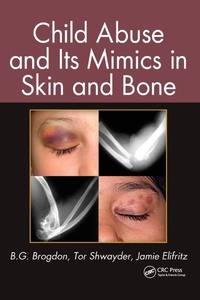 Abbildung von: Child Abuse and its Mimics in Skin and Bone - CRC Press