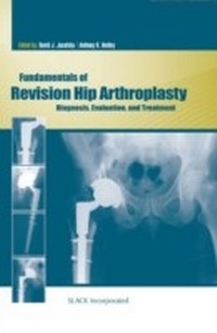 Abbildung von: Fundamentals of Revision Hip Arthroplasty - Slack