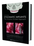 Cover: Zygomatic Implant - Quintessence Publishing Co Ltd