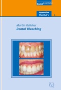 Cover: Dental Bleaching - Quintessence Publishing Co. Ltd.