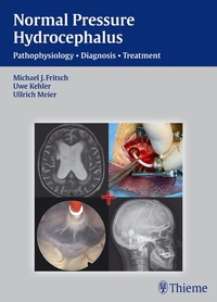 Abbildung von: Normal Pressure Hydrocephalus - Thieme