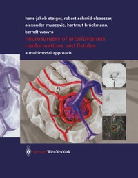 Bild: Neurosurgery of Arteriovenous Malformations and Fistulas - Springer