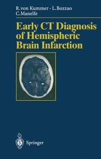 Abbildung von: Early CT Diagnosis of Hemispheric Brain Infarction - Springer
