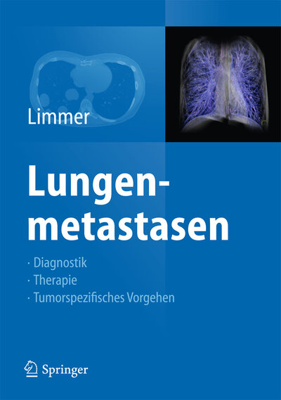Abbildung von: Lungenmetastasen - Springer
