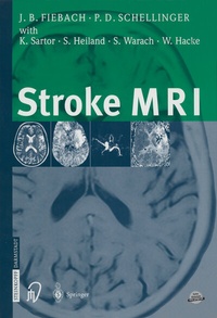 Abbildung von: Stroke MRI - Steinkopff