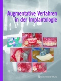 Cover: Augmentative Verfahren in der Implantologie - Quintessenz Verlag