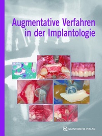 Abbildung von: Augmentative Verfahren in der Implantologie - Quintessenz Verlag