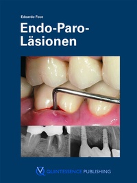 Abbildung von: Endo-Paro-Läsionen - Quintessenz Verlag
