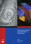 Cover: Partial Breast Irradiation using Multicatheter Brachytherapy - Zuckschwerdt
