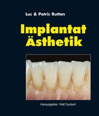 Abbildung von: Implantat-Ästhetik - mgo fachverlage GmbH & Co. KG