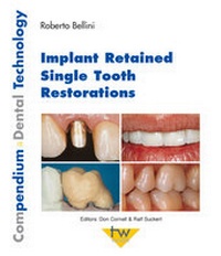 Abbildung von: Implant Retained Single Tooth Restorations - mgo fachverlage GmbH & Co. KG
