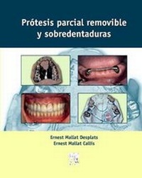 Abbildung von: Protesis Parcial Removible Y Sobredentaduras - Elsevier