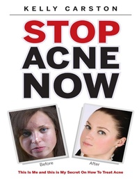 Abbildung von: Stop Acne Now: This Is Me and This Is My Secret On How to Treat Acne - Lulu Publishing Services