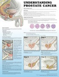 Cover: Understanding Prostate Cancer 2e Laminated - Lippincott Williams and Wilkins