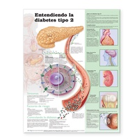 Abbildung von: Understanding Type 2 Diabetes Anatomical Chart in Spanish (Comprendiendo la diabetes tipo 2) - Anatomical Chart Co.