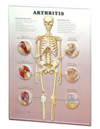 Abbildung von: Arthritis: 3D Lenticular Chart - Anatomical Chart Co.