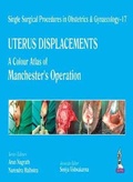 Cover: Single Surgical Procedures in Obstetrics and Gynaecology - 17 - UTERUS DISPLACEMENTS - Jaypee Brothers Medical Publishers