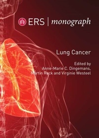 Abbildung von: Lung Cancer - European Respiratory Society