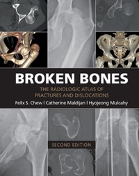 Abbildung von: Broken Bones - Cambridge University Press