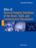 Abbildung von: Atlas of Normal Imaging Variations of the Brain, Skull, and Craniocervical Vasculature - Springer