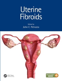 Abbildung von: Uterine Fibroids - CRC Press