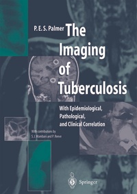 Abbildung von: The Imaging of Tuberculosis - Springer
