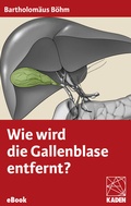 Cover: Wie wird die Gallenblase entfernt? - Kaden, R