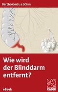 Cover: Wie wird der Blinddarm entfernt? - Kaden, R