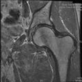 Cover: Femoral Neck Fractures Treatment - American Academy of Orthopaedic Surgeons