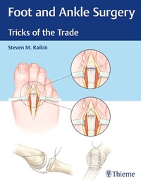 Abbildung von: Foot and Ankle Surgery - Thieme Publishers