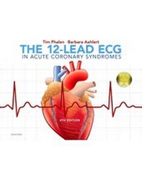 Abbildung von: The 12-Lead ECG in Acute Coronary Syndromes - Mosby/JEMS