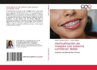 Abbildung von: Verticalizacion de molares con sistema cantilever doble - Editorial Academica Espanola