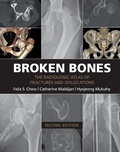 Cover: Broken Bones - Cambridge University Press