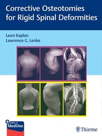 Enlarge image Cover: Corrective Osteotomies for Rigid Spinal Deformities - Thieme