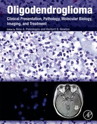 Abbildung von: Oligodendroglioma - Academic Press