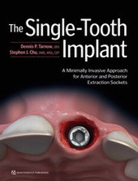 Abbildung von: The Single-Tooth Implant - Quintessence Publishing Co Inc.,U.S.
