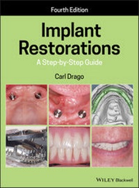 Abbildung von: Implant Restorations - Wiley
