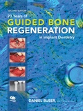 Cover: 20 Years of Guided Bone Regeneration in Implant Dentistry - Quintessence Publishing Co, Inc