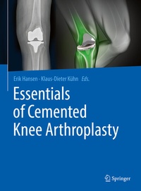 Abbildung von: Essentials of Cemented Knee Arthroplasty - Springer
