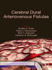 Abbildung von: Cerebral Dural Arteriovenous Fistulas - Academic Press