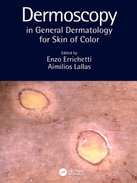 Abbildung von: Dermoscopy in General Dermatology for Skin of Color - CRC Press