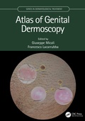 Cover: Atlas of Genital Dermoscopy - CRC Press