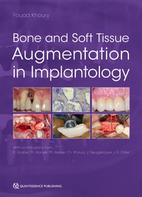 Abbildung von: Bone and Soft Tissue Augmentation in Implantology - Quintessence Publishing Co. Ltd.
