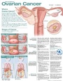 Cover: Understanding Ovarian Cancer Anatomical Chart - WOLTERS KLUWER HEALTH