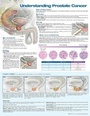 Cover: Understanding Prostate Cancer Anatomical Chart - WOLTERS KLUWER HEALTH