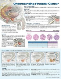 Enlarge image Cover: Understanding Prostate Cancer Anatomical Chart - WOLTERS KLUWER HEALTH
