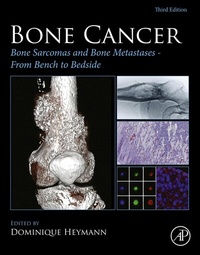 Abbildung von: Bone Cancer - Academic Press