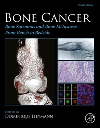 Bild: Bone Cancer - Academic Press