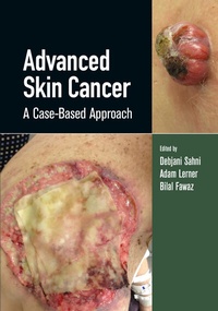 Enlarge image Cover: Advanced Skin Cancer - CRC Press